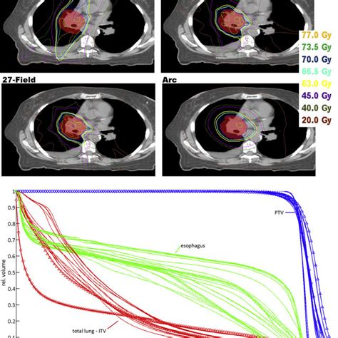 An Example Of Dose Distribution Between Vmat And Imrt Breast Cancer