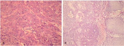 Figure 1 From Recurrent Squamous Cell Carcinoma Arising In A Neglected Pilonidal Sinus Report