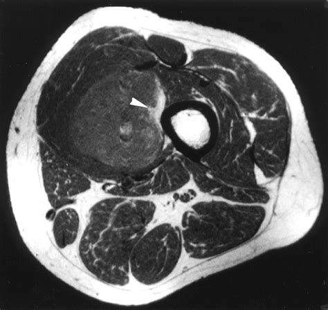 Prognostic Significance Of MRI Findings In Patients With MyxoidRound