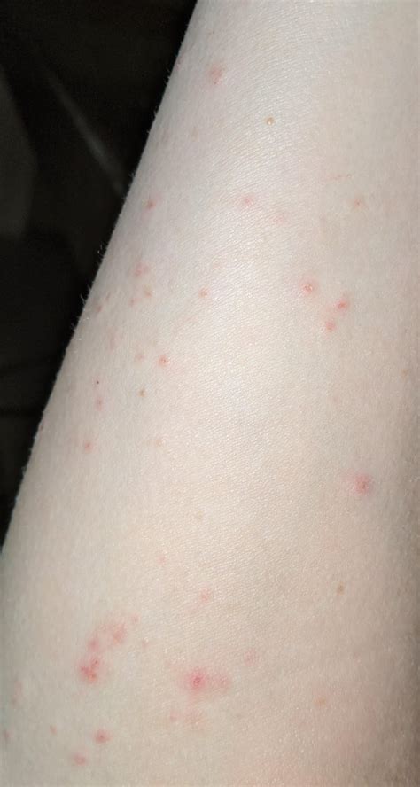 Have These Little Itchy Scabs On My Arms And Legs Ive Tried Diff Types Of Lotion And Nothing