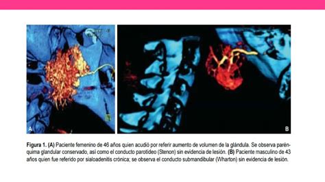 Tumores Y Patologias De Glandulas Salivales Pptx