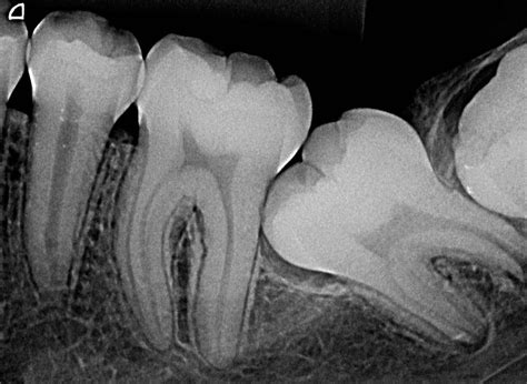 RX Periapical Clínica Dental Cevallos