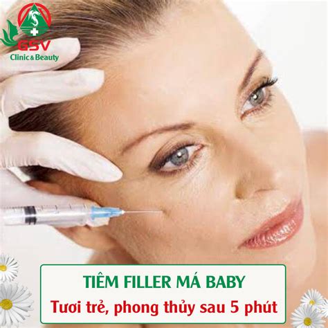 Tiêm Filler Má Baby Khuôn Mặt đầy đặn Sau 10 Phút Da Liễu Thẩm Mỹ Gsv