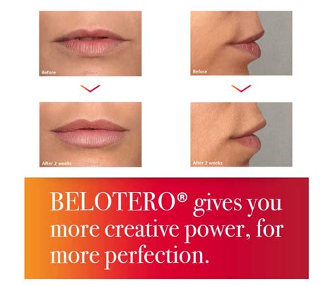 Belotero lips at My Face Aesthetics Clinic Bolton Gt Manchester