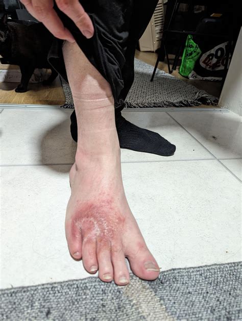 Skin infection on foot unknown diagnosis : r/MedicalGore