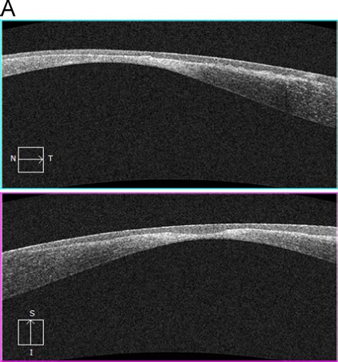 Corneal Melt Following Collagen Crosslinking And Topography Guided