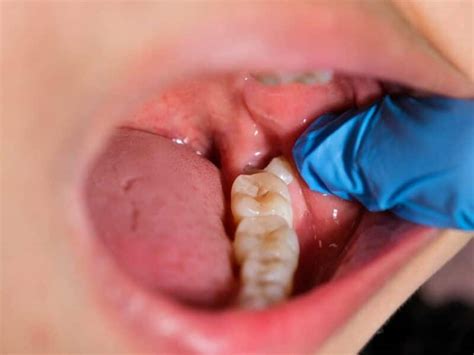 Why Wisdom Teeth Removal Is Important For Dental Health Hamilton Dental Emergency Centre