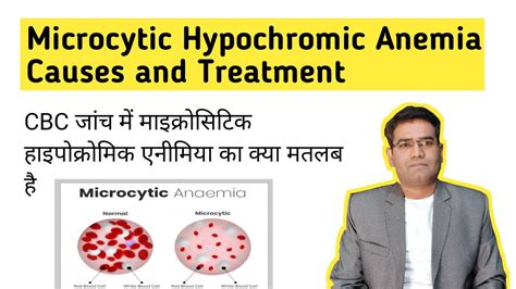 What is Microcytic Hypochromic Anemia? its Causes and Treatment (in ...