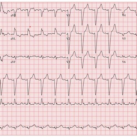 peaked T waves resolved after the patient's potassium normalized ...