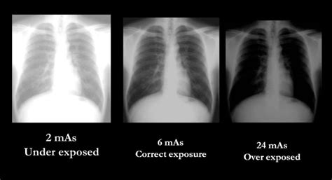 Exposure To X Ray