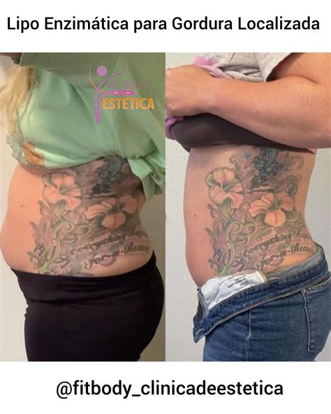 Lipo Enzim Tica Para Gordura Localizada Cl Nica Fit Body Est Tica