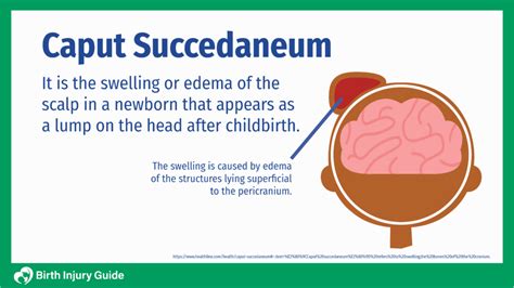 caput succedaneum  treatment   birth injury guide