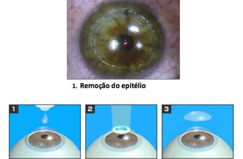 Cirurgia Refrativa Oftalmologista Mutton Sorocaba