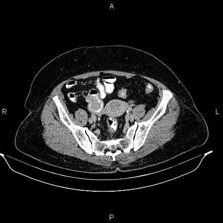 Ileoileal Intussusception Due To Gastrointestinal Stromal Tumour