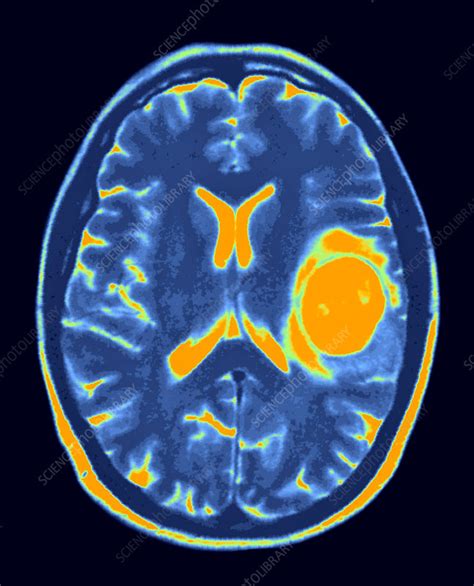 Glioblastoma Mri Scan Stock Image C Science Photo Library