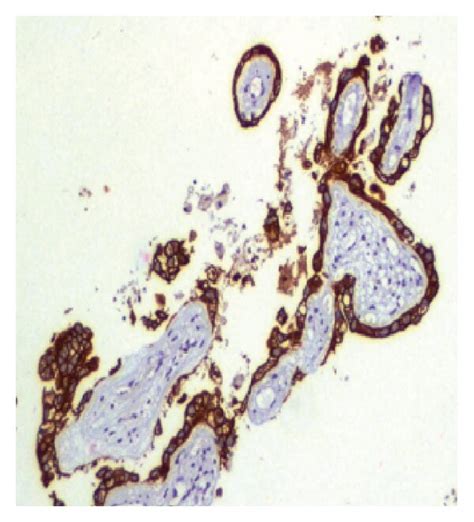 A Gastric Adenocarcinoma Papillary Growth Pattern B Gastric Tumor