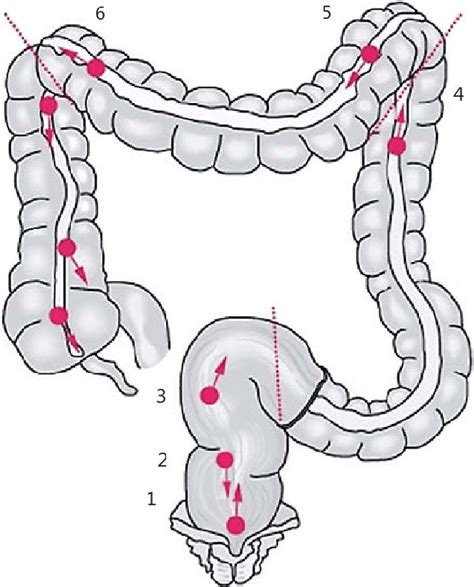 What Problems Does a Tortuous Colon Cause?