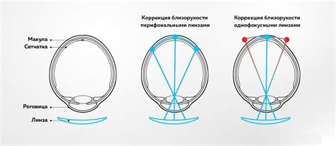 Перифокальные очки — что это, советы по выбору, цены