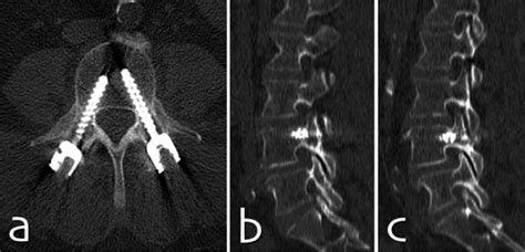 Pedicle Fracture