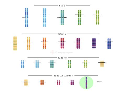 A Karyotype Of Turner Syndrome Explained KaryotypingHub