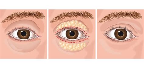Olhos Pesados E Sonolência - Você tem peso nos olhos? Sente sono constantemente?