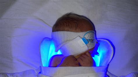 Phototherapy For Jaundice Babies