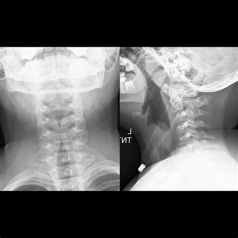 Croup Pediatric Radiology Reference Article Pediatric Imaging Pedsimaging