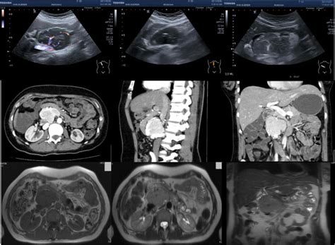 Pre Operative Ultrasound Computed Tomography And Magnetic Resonance