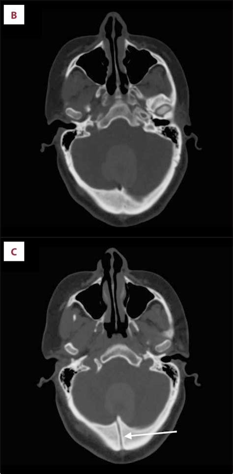 Figure 2 From A Rare Case Of An Intracranial Dermoid Cyst With Atypical