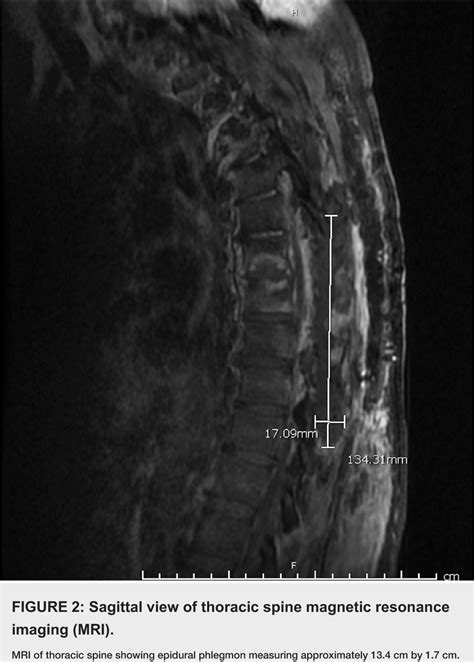 Figure 2 From Thoracic Discitis In Ankylosing Spondylitis Semantic