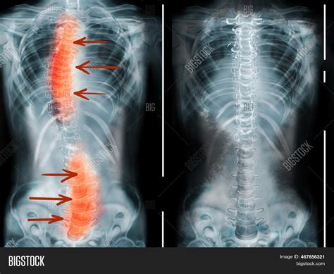 X Rays Human Normal Image And Photo Free Trial Bigstock