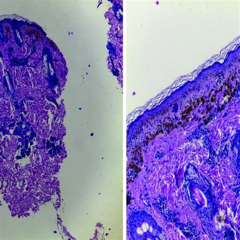 PDF Líquen Plano Pigmentoso Apresentação Atípica Simulando uma