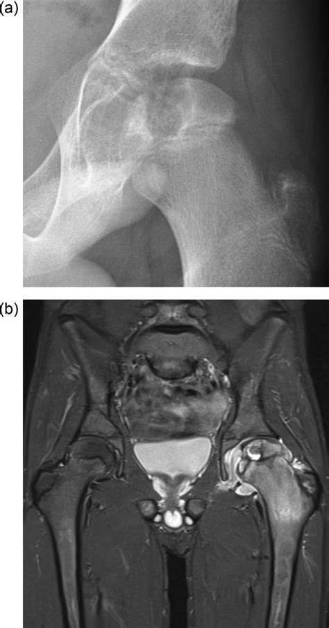 A Radiograph Showing A Chondroblastoma Located In The Epiphysis Of