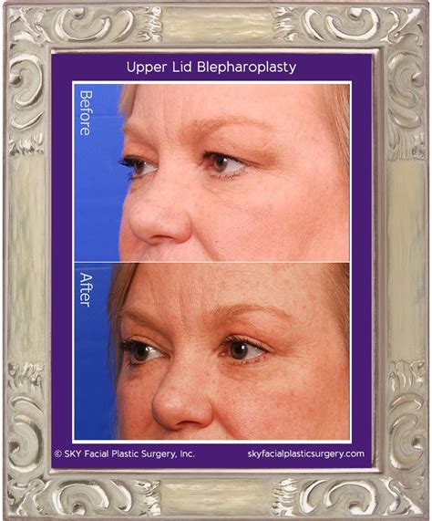 Blepharoplasty Eighteen — Sky Facial Plastic Surgery