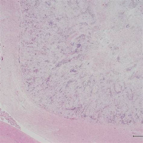 Histopathology Of The Intracranial Granulomas Lesion A The