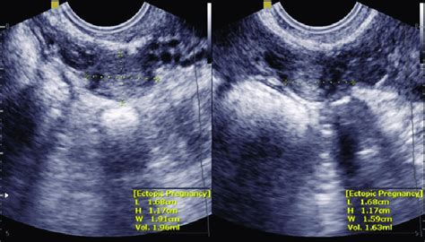 Tvs Of An Ectopic Mass Consistent With Ep Of 19 Mm In Terms Of Its Download Scientific Diagram