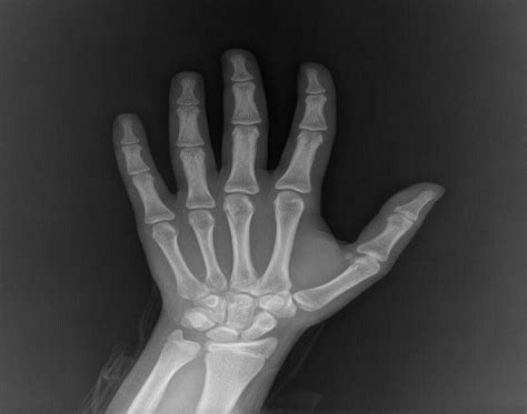 Example of left-hand X-ray, PA view | Download Scientific Diagram