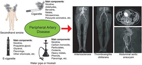 Peripheral Artery Disease Pathophysiology