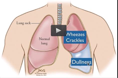 Respiratory lecture 9/22/22 pleural effusion, Lung CA, Pneumonectomy ...