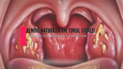 Tonsil Stones Learn What They Are And How To Remove Them Naturally