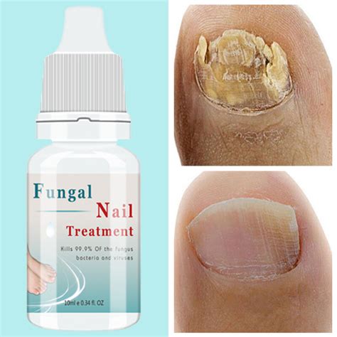 Nail Fungus Treatment Serum Foot Repair Liquid Toe Nails Fungal Removal