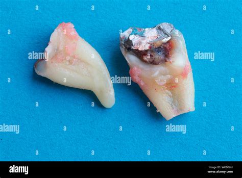 Broken Molar Filling