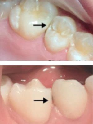 Silver Diamine Fluoride Tooth Dental
