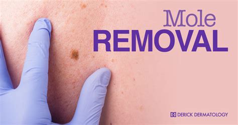 Melanoma and Mole Removal | Medical Dermatology | Derick Dermatology