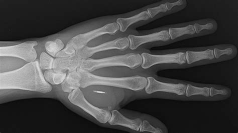 The Microchip Implants That Let You Pay With Your Hand Bbc News