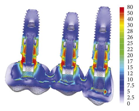 The Von Mises Stress Distribution On Implant Abutment In The Oblique Download Scientific