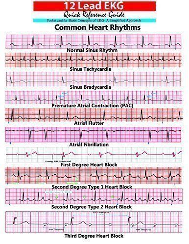 Interpret Ekgs Strips Like A Boss Ekg Interpretation For Nurses