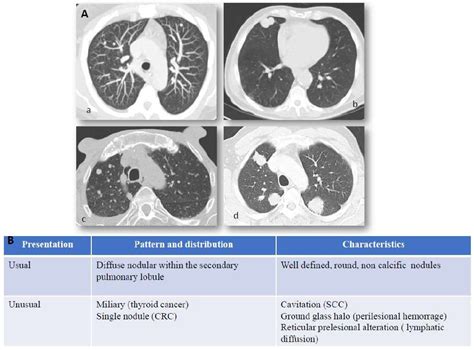 Lung Cancer Metastasis Symptoms