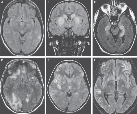 自己免疫性脳炎 Autoimmune Encephalitis│医學事始 いがくことはじめ