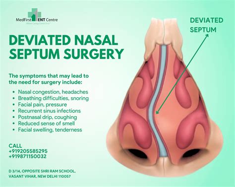 Understanding And Treating A Deviated Nasal Septum Explained By Dr